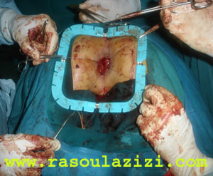 تصوير عمل جراحي براي درمان بيرون زدگي رکتوم از مقعد - پرولاپس مقعد